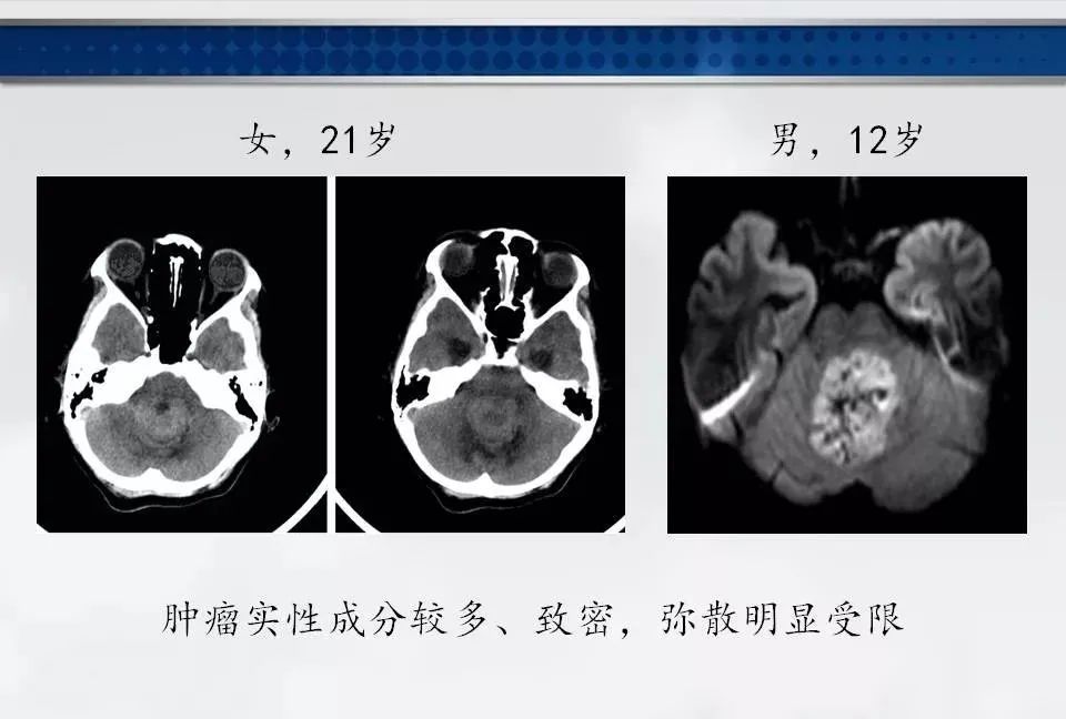影像PPT - 【PPT】四脑室肿瘤影像诊断与鉴别诊断-13