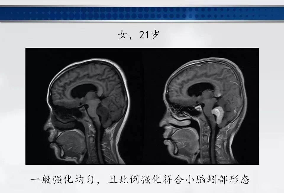 影像PPT - 【PPT】四脑室肿瘤影像诊断与鉴别诊断-14