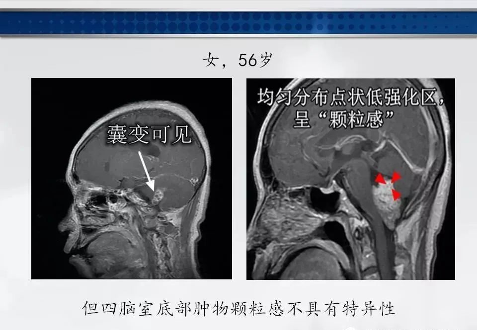 影像PPT - 【PPT】四脑室肿瘤影像诊断与鉴别诊断-16