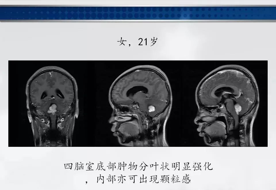影像PPT - 【PPT】四脑室肿瘤影像诊断与鉴别诊断-18