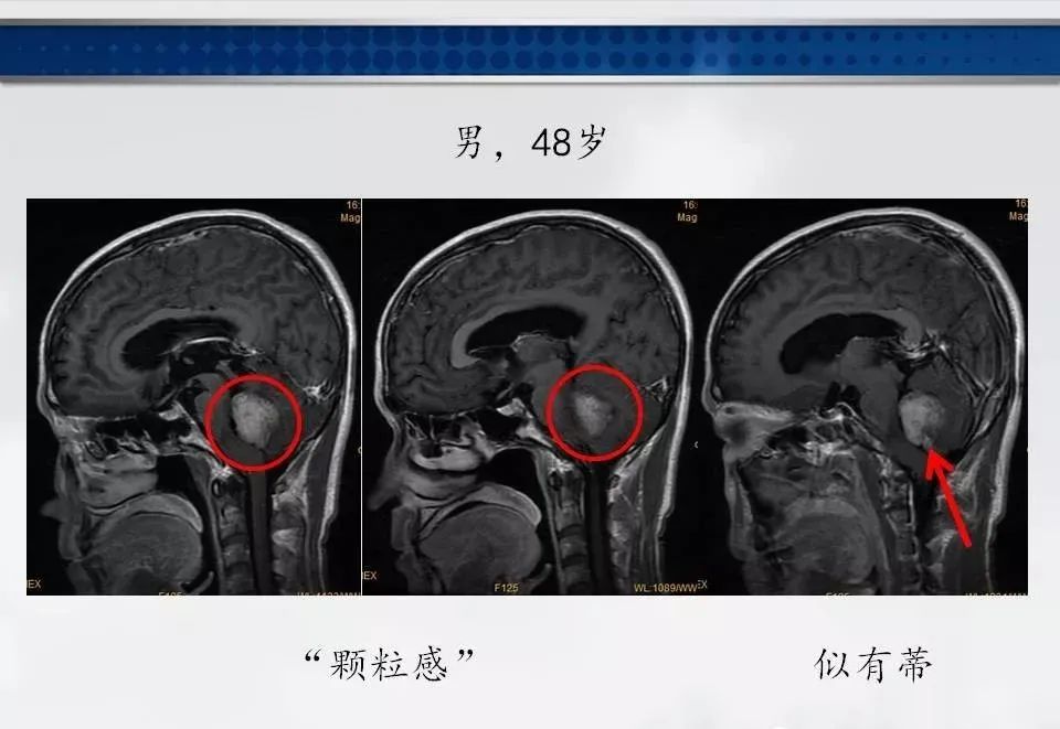 影像PPT - 【PPT】四脑室肿瘤影像诊断与鉴别诊断-19