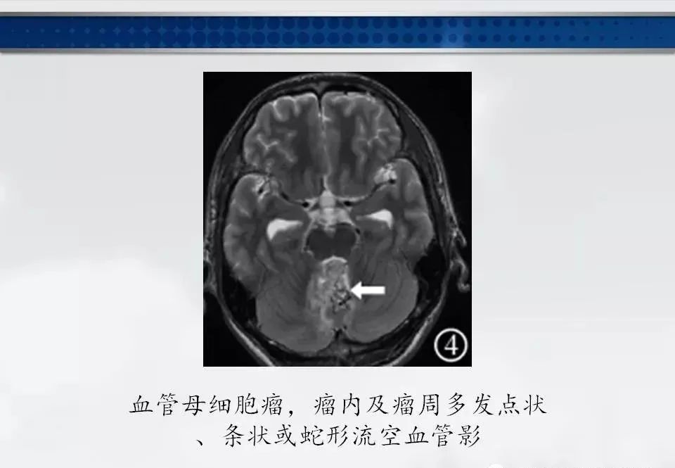 影像PPT - 【PPT】四脑室肿瘤影像诊断与鉴别诊断-23