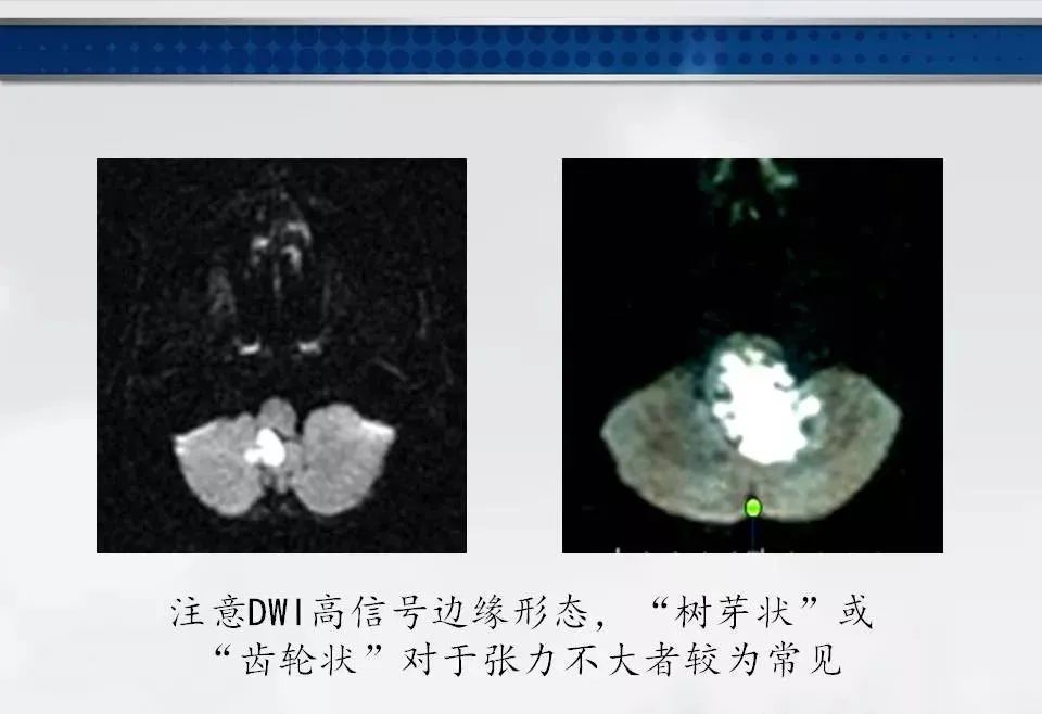 影像PPT - 【PPT】四脑室肿瘤影像诊断与鉴别诊断-24