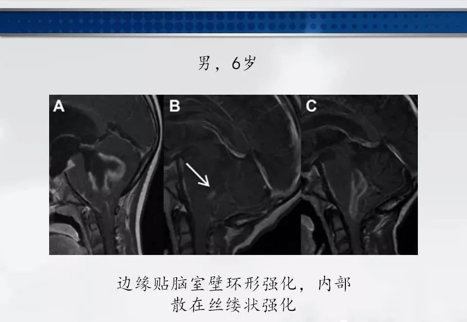 影像PPT - 【PPT】四脑室肿瘤影像诊断与鉴别诊断-26