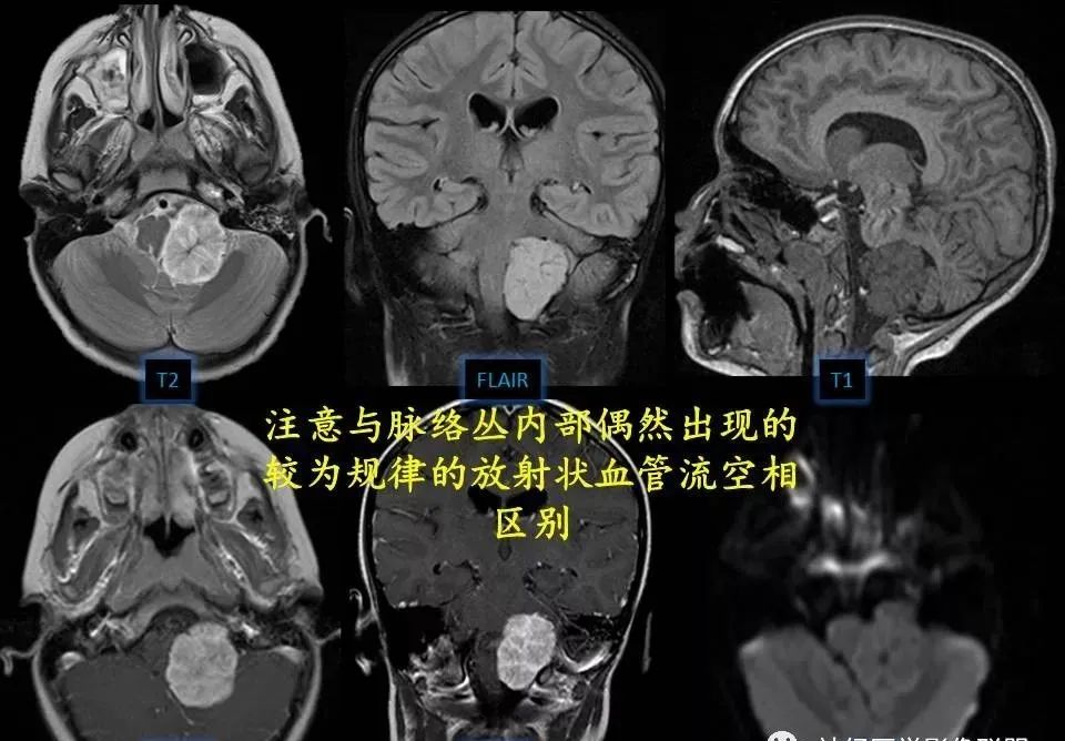 影像PPT - 【PPT】四脑室肿瘤影像诊断与鉴别诊断-31