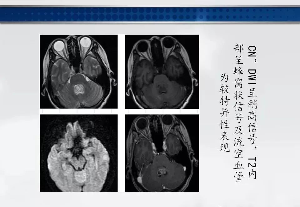 影像PPT - 【PPT】四脑室肿瘤影像诊断与鉴别诊断-33