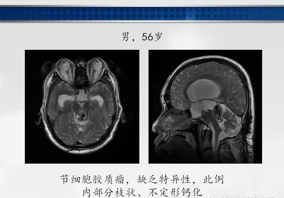 影像PPT - 【PPT】四脑室肿瘤影像诊断与鉴别诊断-34