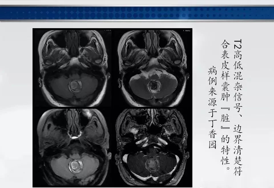 影像PPT - 【PPT】四脑室肿瘤影像诊断与鉴别诊断-39