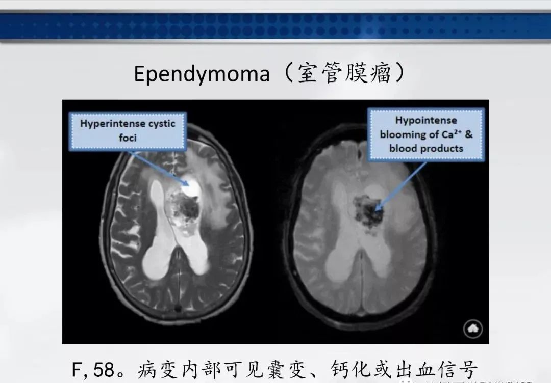 影像PPT - 【PPT】侧脑室肿瘤影像诊断及鉴别诊断-5