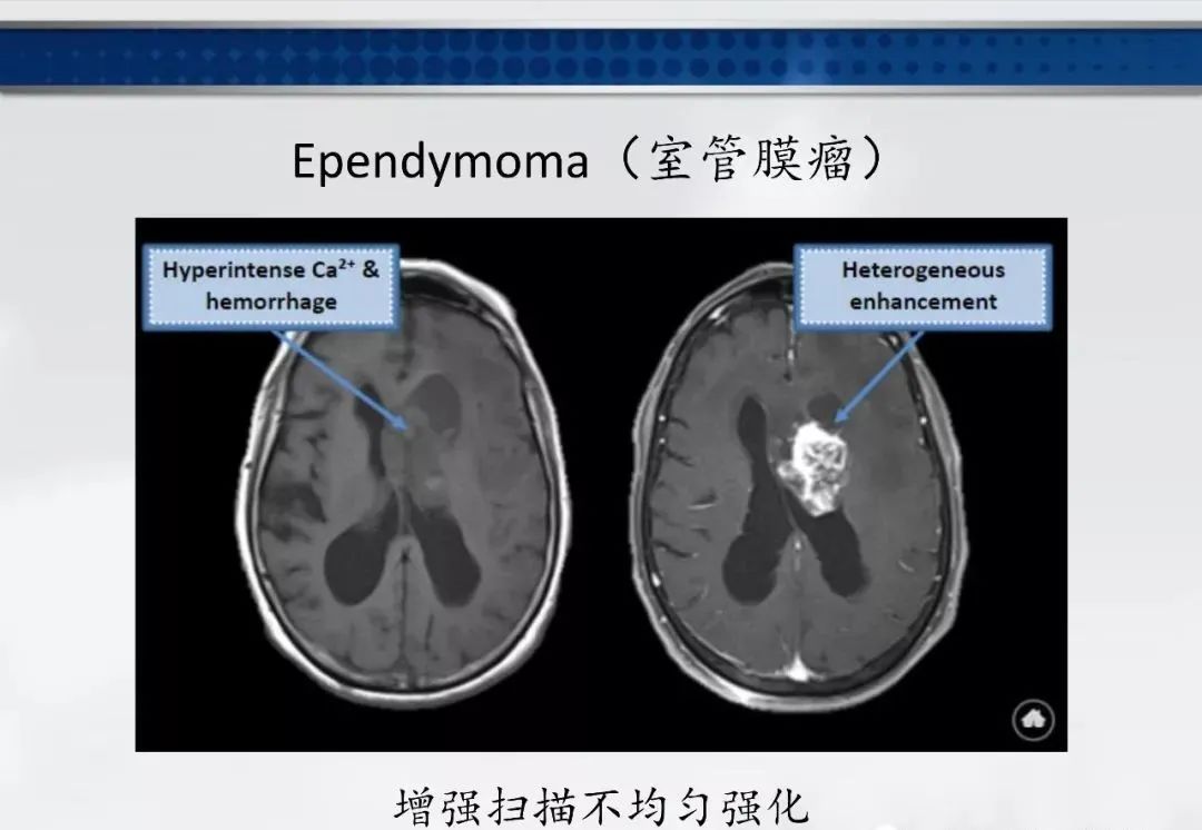 影像PPT - 【PPT】侧脑室肿瘤影像诊断及鉴别诊断-6