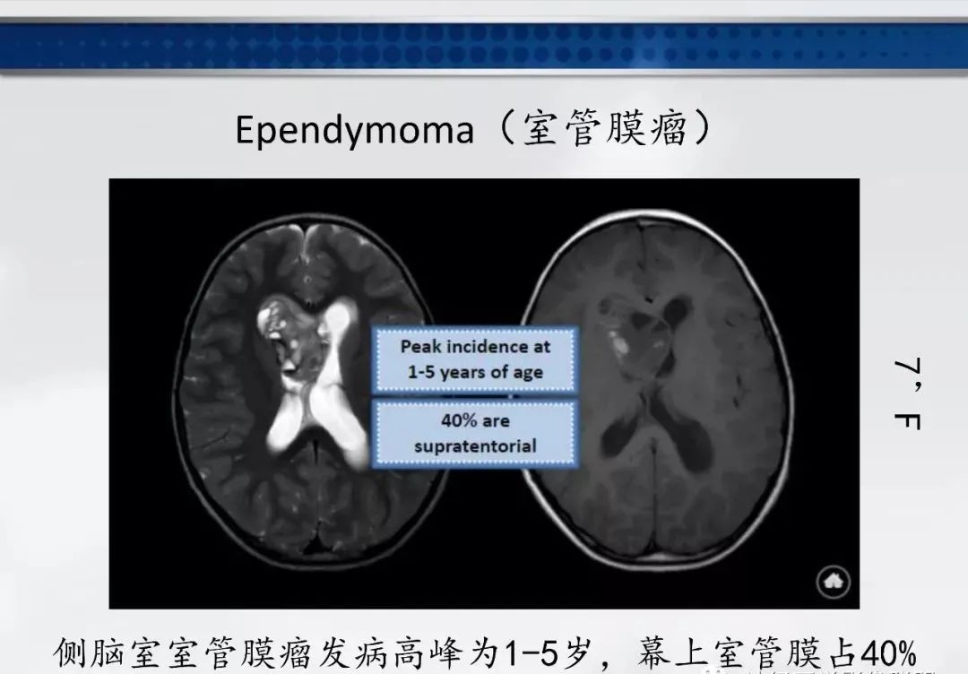 影像PPT - 【PPT】侧脑室肿瘤影像诊断及鉴别诊断-7