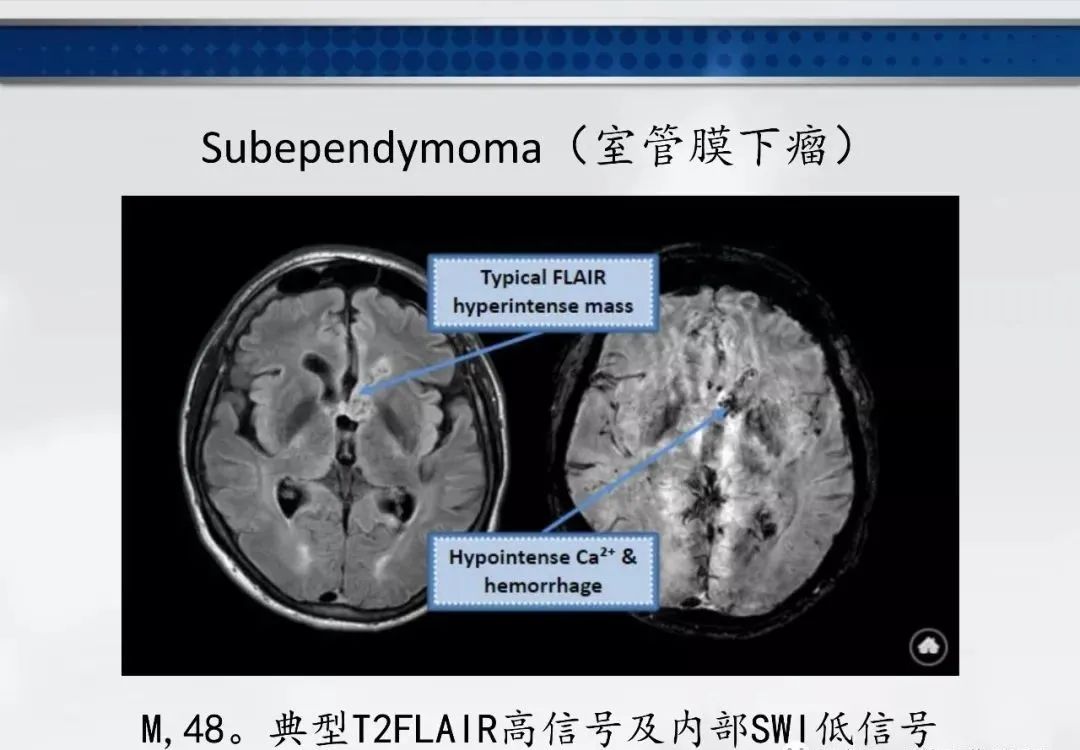 影像PPT - 【PPT】侧脑室肿瘤影像诊断及鉴别诊断-9