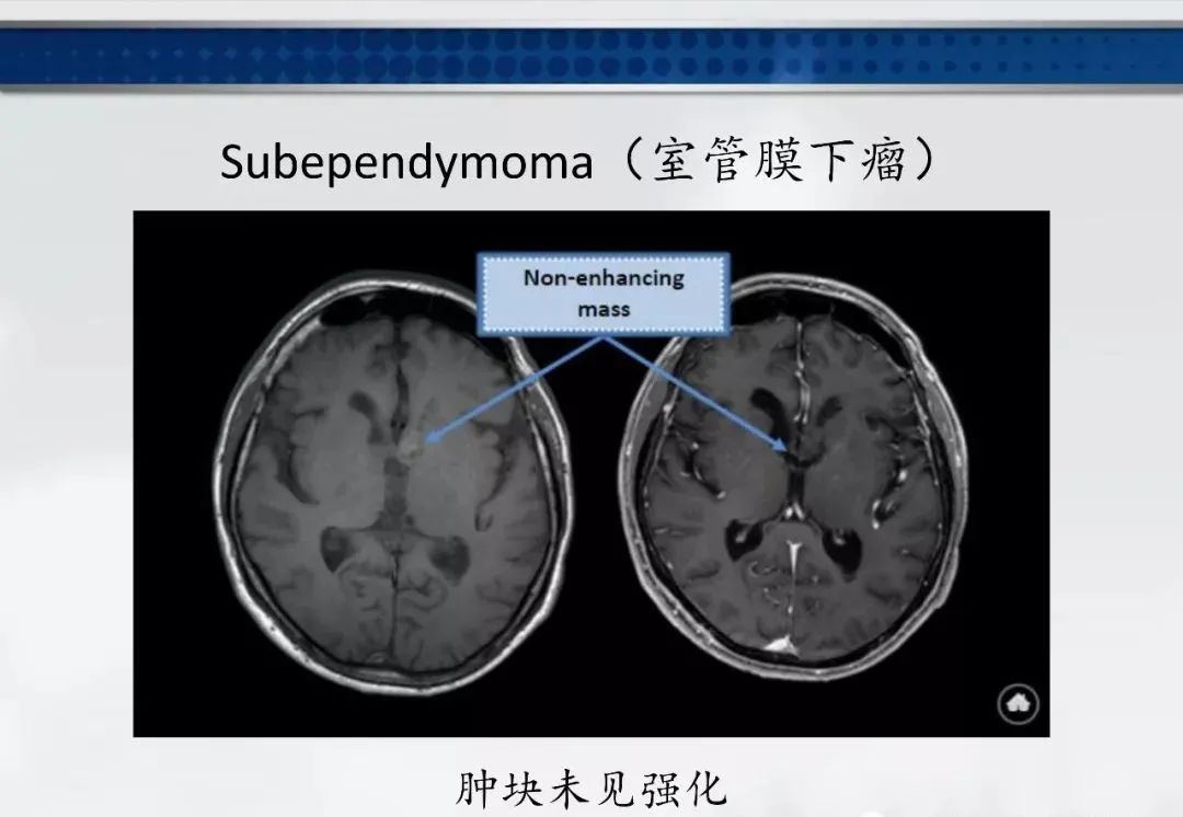 影像PPT - 【PPT】侧脑室肿瘤影像诊断及鉴别诊断-10