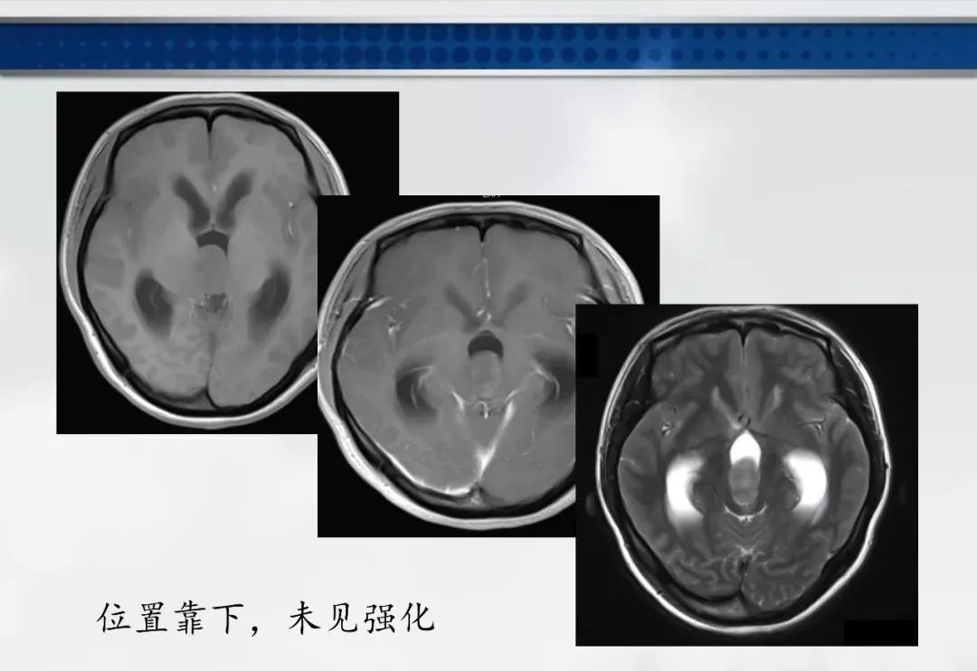 影像PPT - 【PPT】侧脑室肿瘤影像诊断及鉴别诊断-11