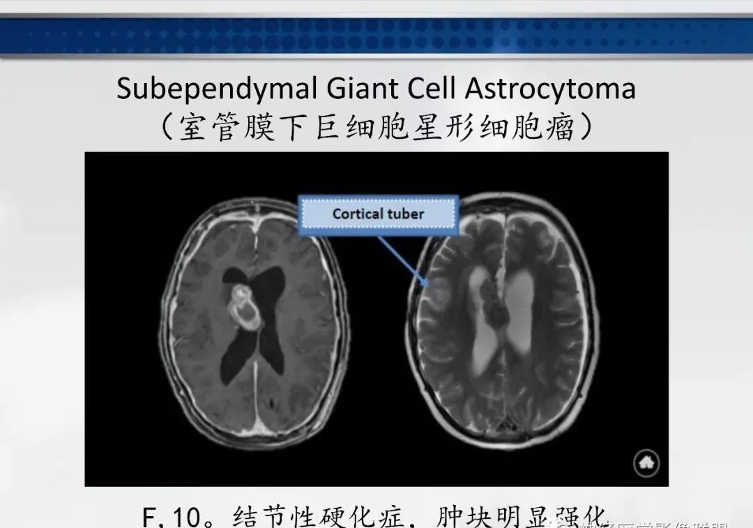 影像PPT - 【PPT】侧脑室肿瘤影像诊断及鉴别诊断-12