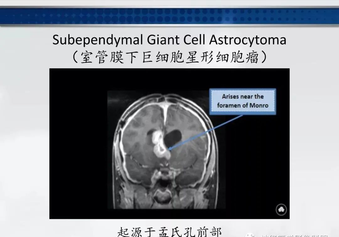 影像PPT - 【PPT】侧脑室肿瘤影像诊断及鉴别诊断-13