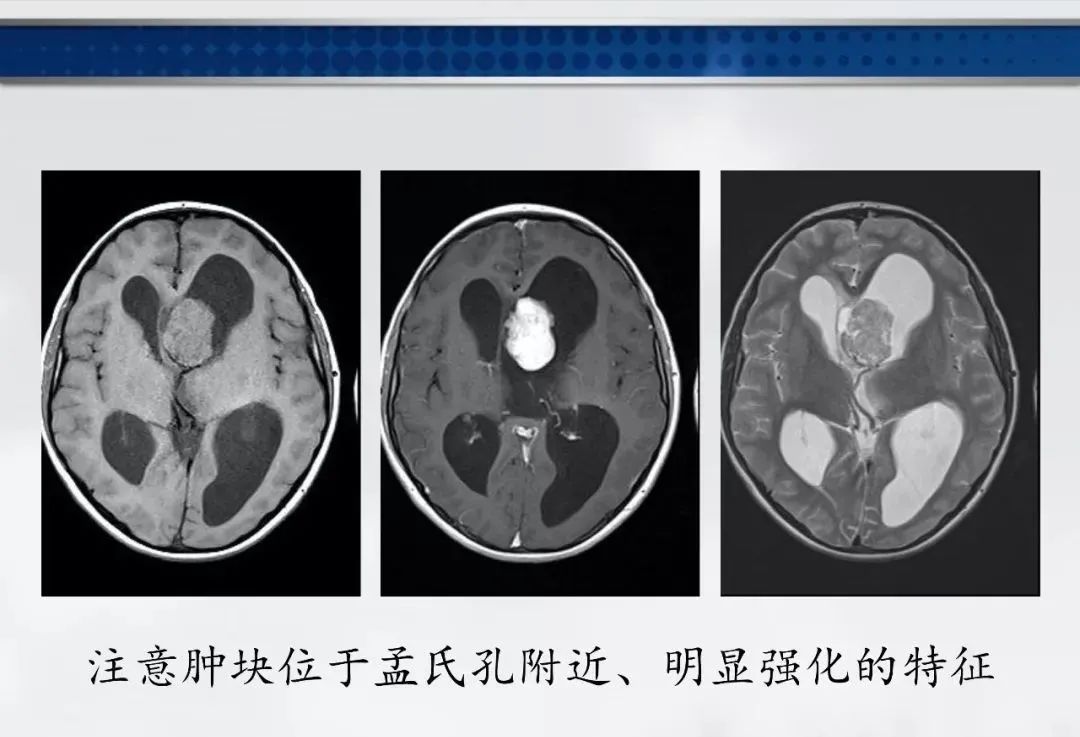 影像PPT - 【PPT】侧脑室肿瘤影像诊断及鉴别诊断-14