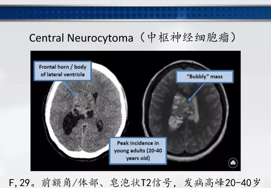 影像PPT - 【PPT】侧脑室肿瘤影像诊断及鉴别诊断-15