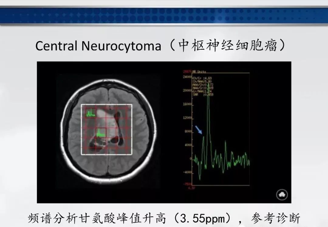 影像PPT - 【PPT】侧脑室肿瘤影像诊断及鉴别诊断-16