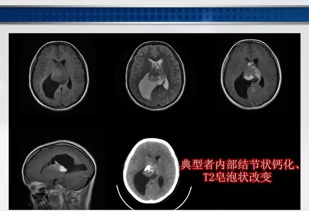 影像PPT - 【PPT】侧脑室肿瘤影像诊断及鉴别诊断-17