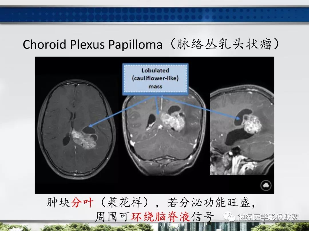 影像PPT - 【PPT】侧脑室肿瘤影像诊断及鉴别诊断-19