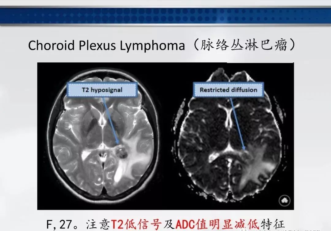 影像PPT - 【PPT】侧脑室肿瘤影像诊断及鉴别诊断-21