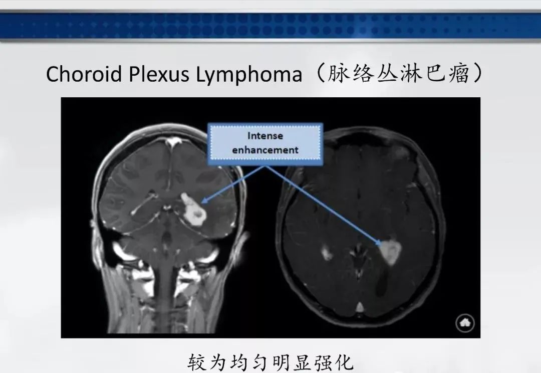影像PPT - 【PPT】侧脑室肿瘤影像诊断及鉴别诊断-22