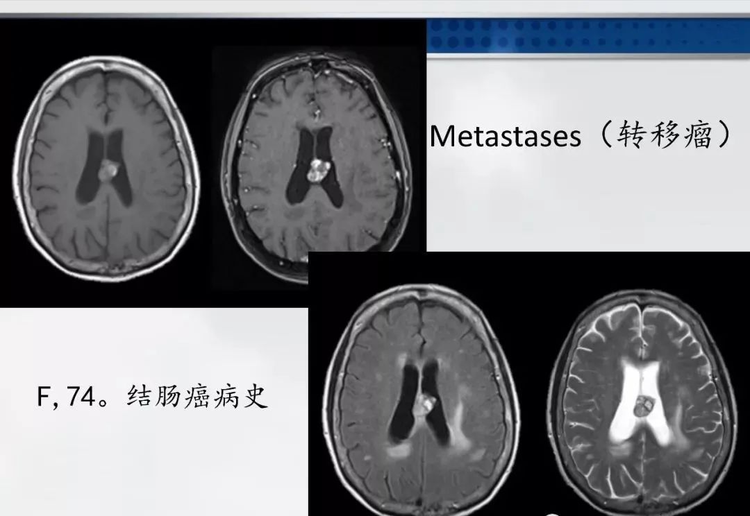 影像PPT - 【PPT】侧脑室肿瘤影像诊断及鉴别诊断-23