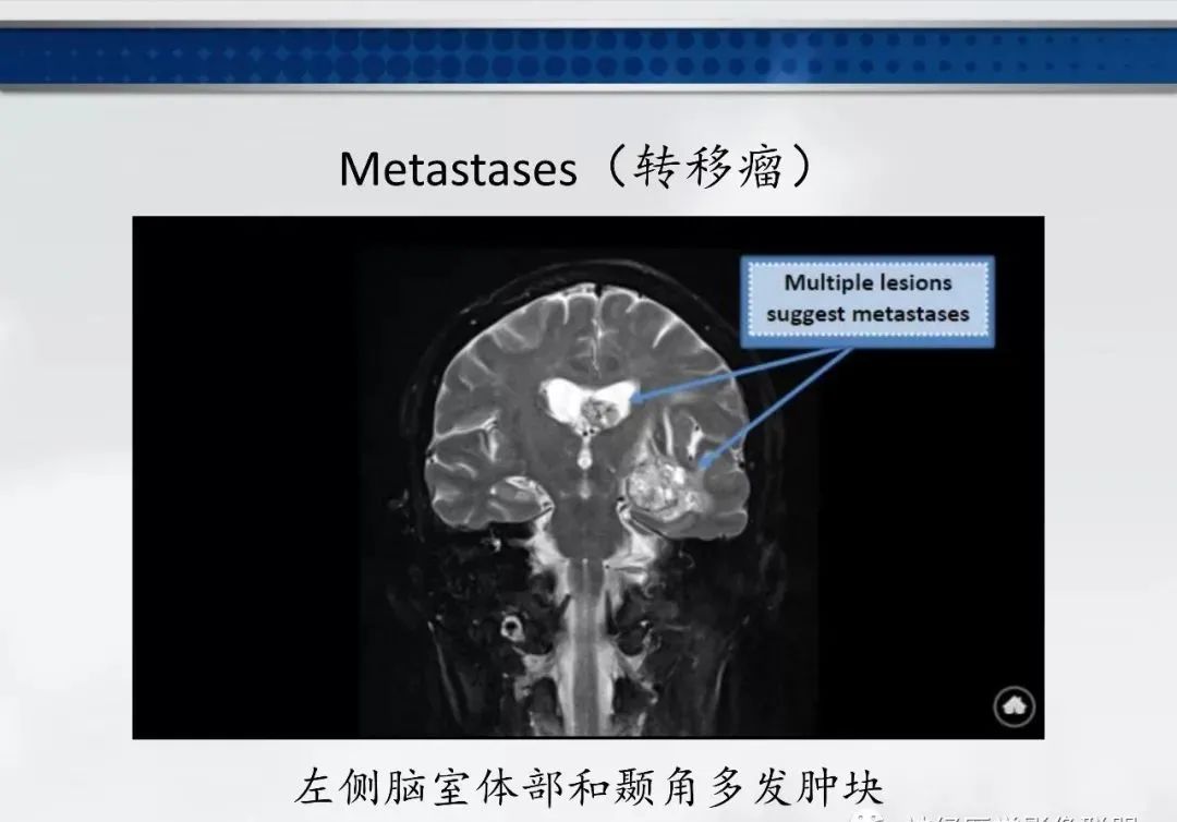 影像PPT - 【PPT】侧脑室肿瘤影像诊断及鉴别诊断-24