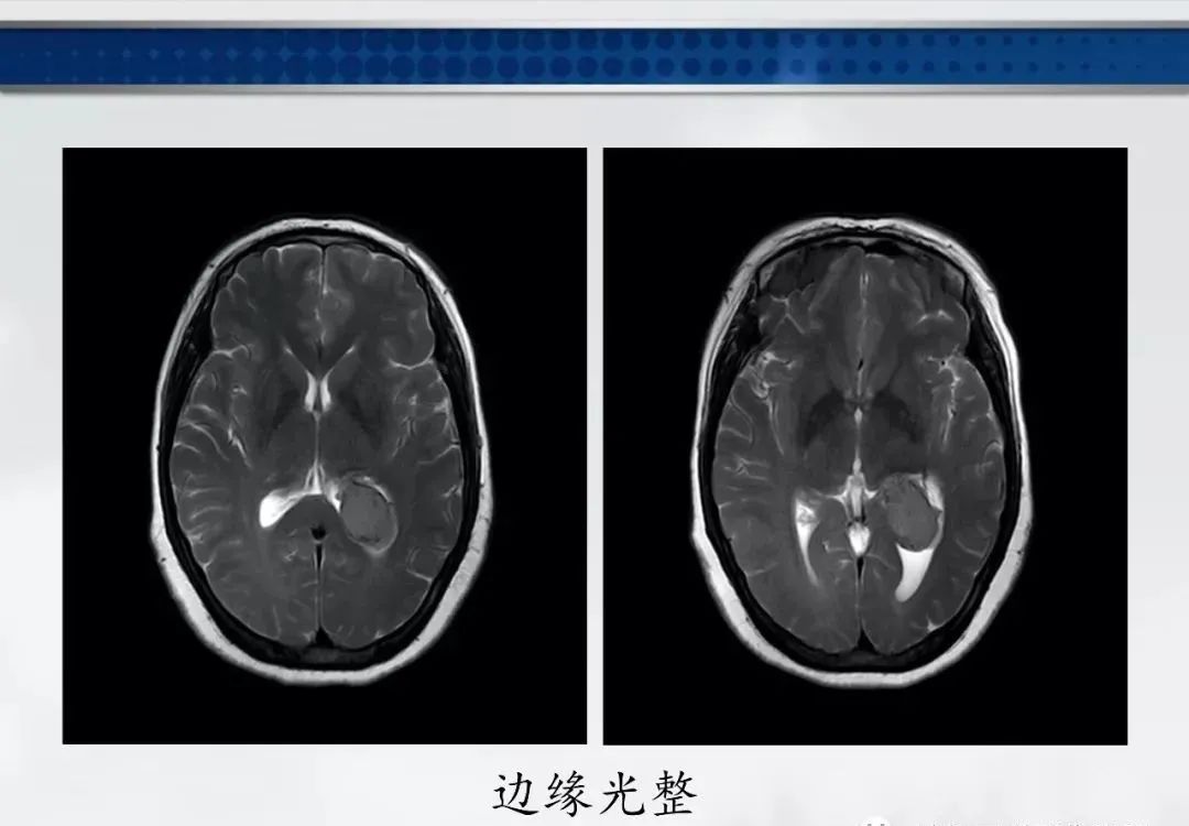 影像PPT - 【PPT】侧脑室肿瘤影像诊断及鉴别诊断-26