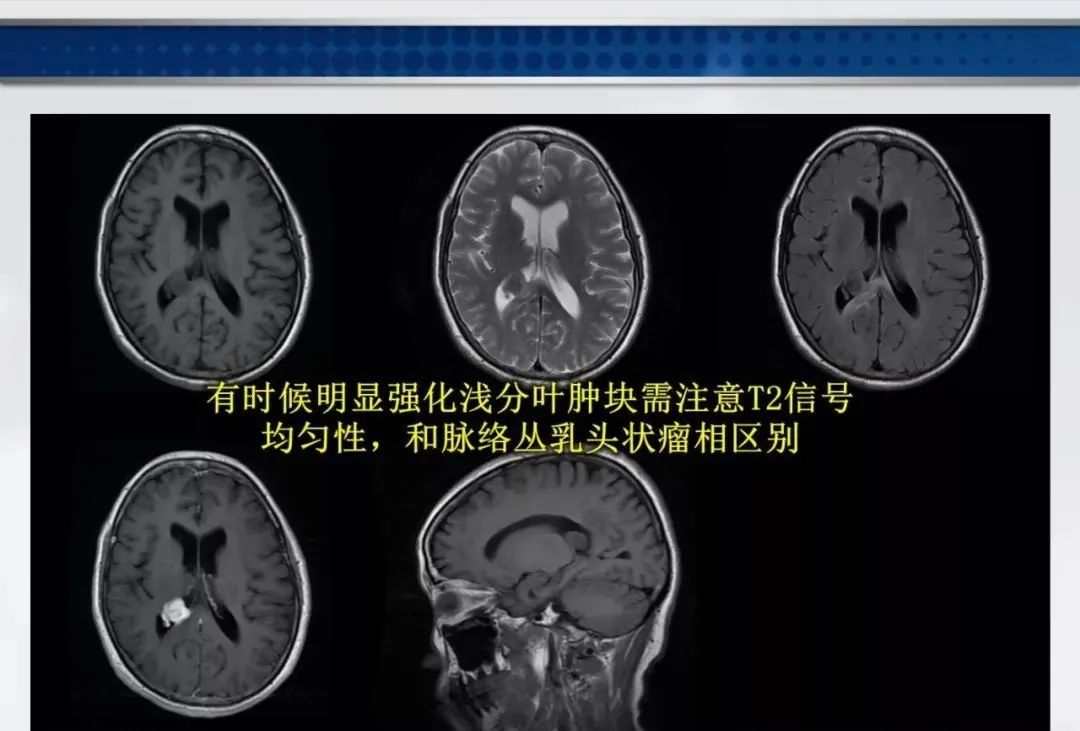 影像PPT - 【PPT】侧脑室肿瘤影像诊断及鉴别诊断-27