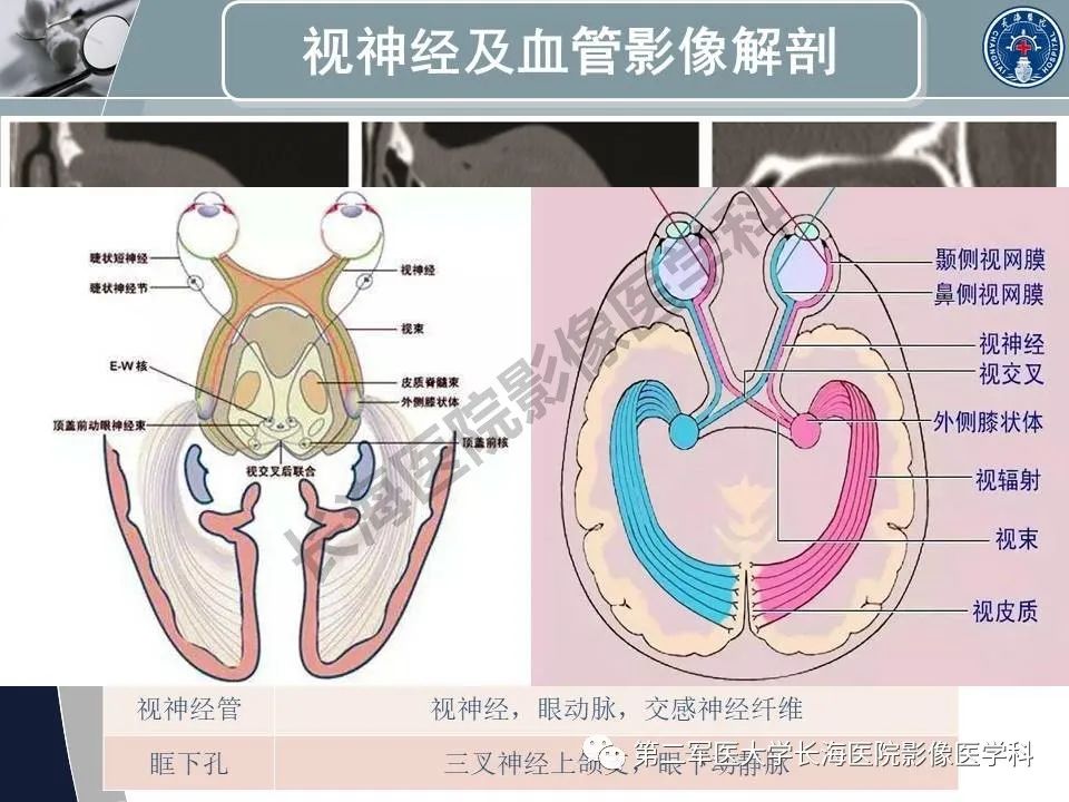 影像PPT - 【PPT】眼眶内肿瘤的影像诊断-6
