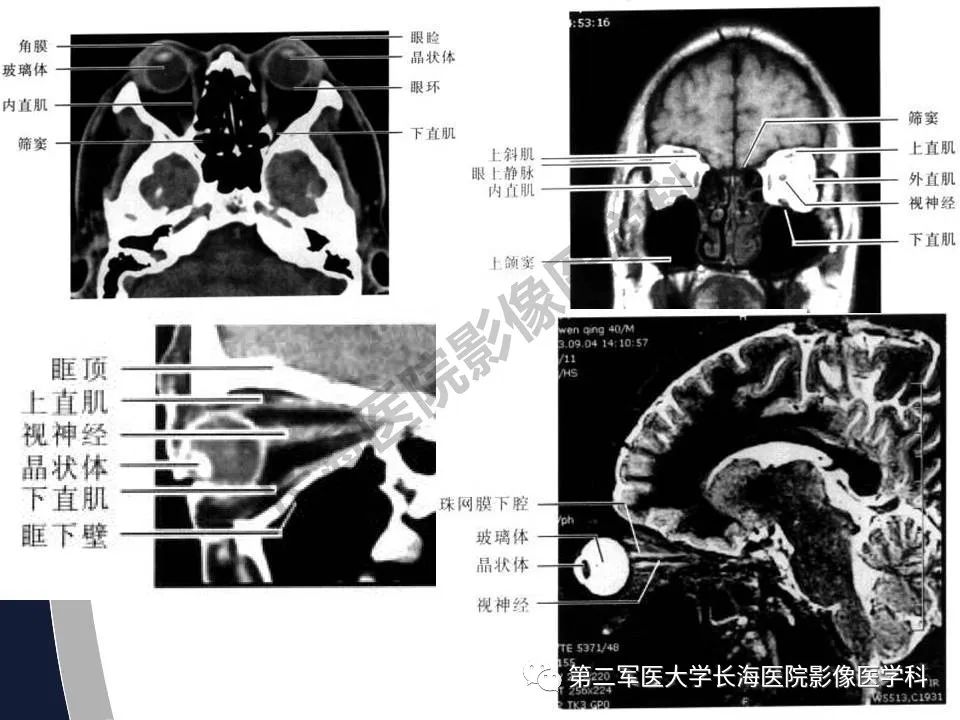 影像PPT - 【PPT】眼眶内肿瘤的影像诊断-7