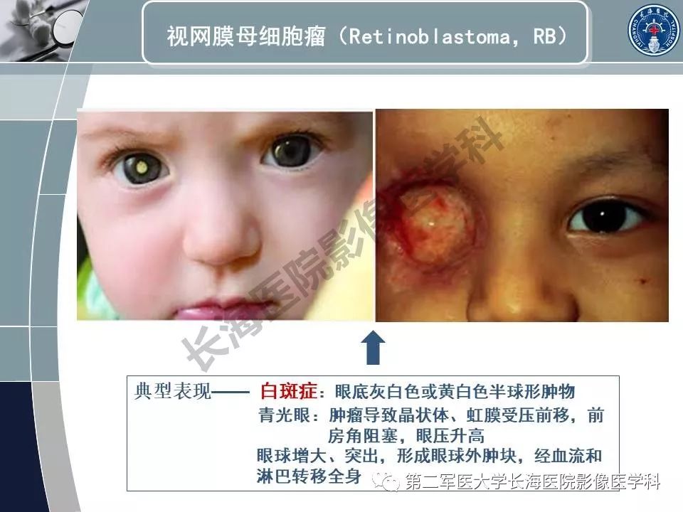 影像PPT - 【PPT】眼眶内肿瘤的影像诊断-12