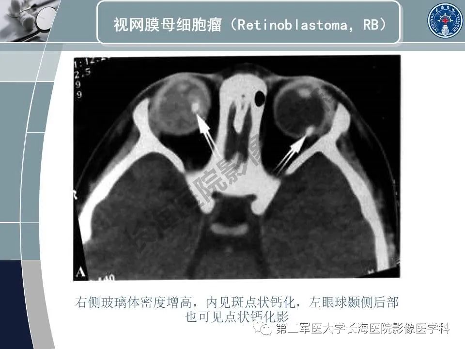 影像PPT - 【PPT】眼眶内肿瘤的影像诊断-14