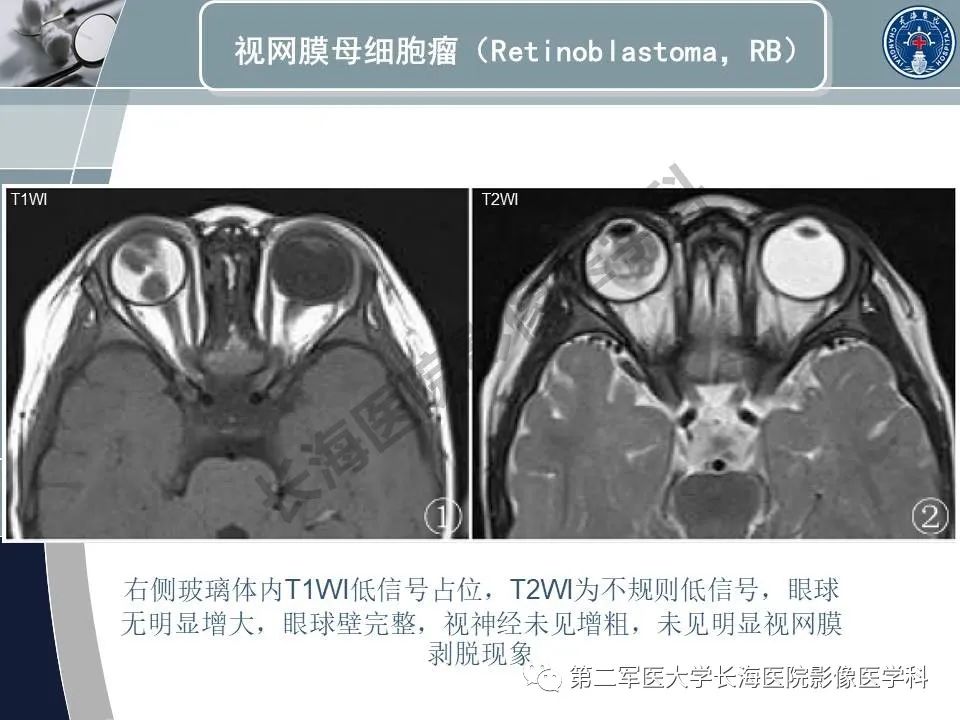影像PPT - 【PPT】眼眶内肿瘤的影像诊断-15