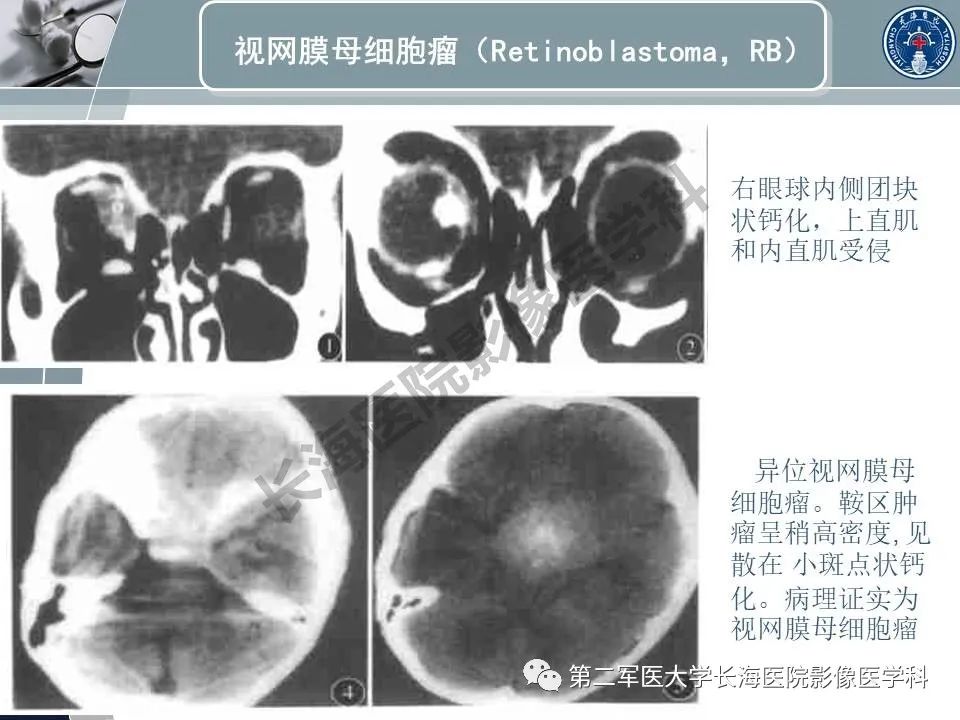 影像PPT - 【PPT】眼眶内肿瘤的影像诊断-16