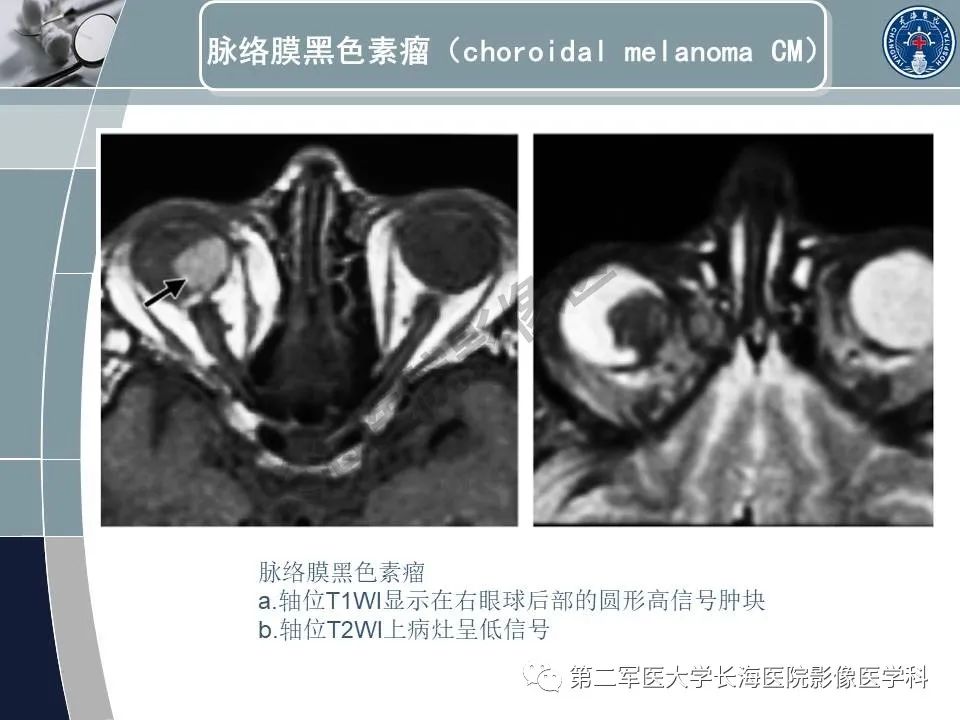 影像PPT - 【PPT】眼眶内肿瘤的影像诊断-21