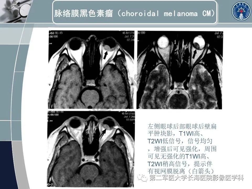 影像PPT - 【PPT】眼眶内肿瘤的影像诊断-22