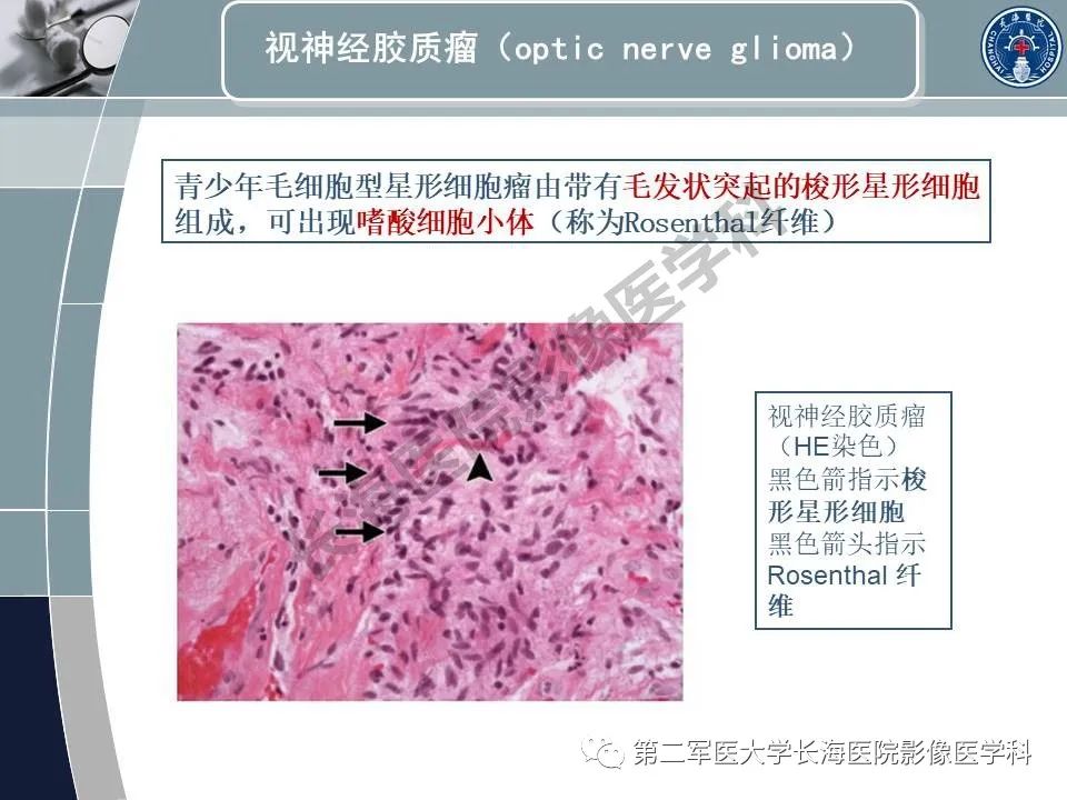 影像PPT - 【PPT】眼眶内肿瘤的影像诊断-26