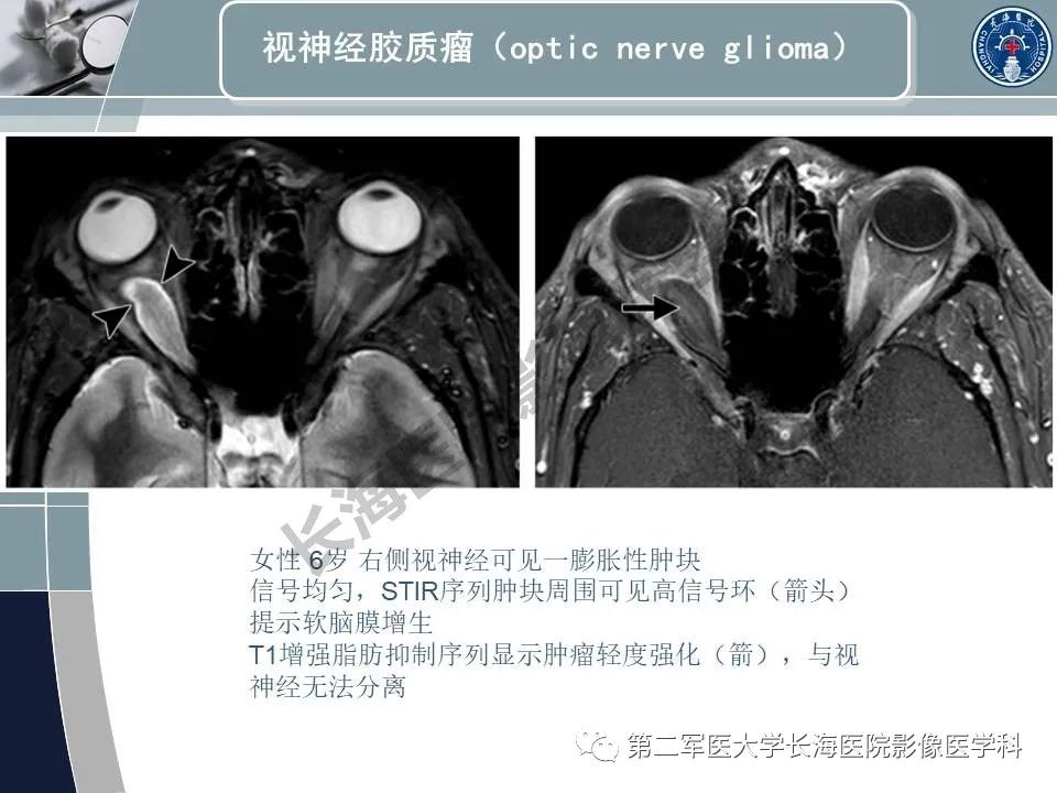 影像PPT - 【PPT】眼眶内肿瘤的影像诊断-28