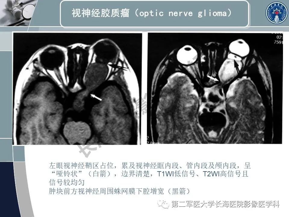影像PPT - 【PPT】眼眶内肿瘤的影像诊断-29