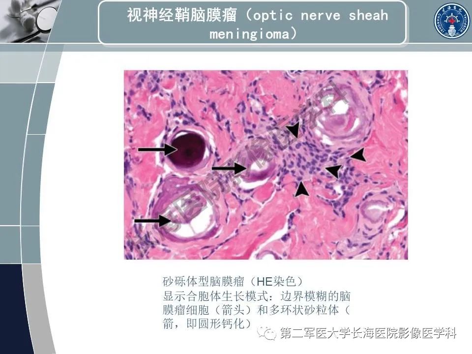 影像PPT - 【PPT】眼眶内肿瘤的影像诊断-32