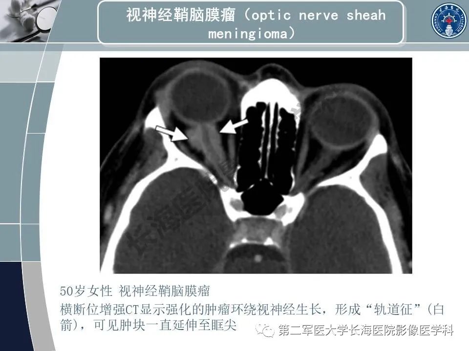 影像PPT - 【PPT】眼眶内肿瘤的影像诊断-34