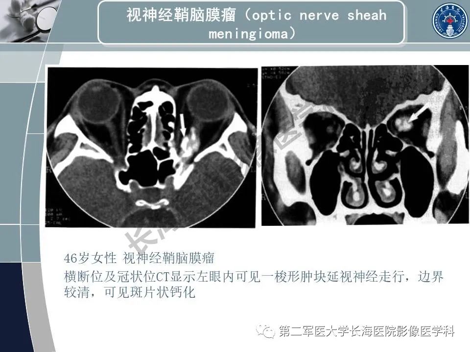 影像PPT - 【PPT】眼眶内肿瘤的影像诊断-35