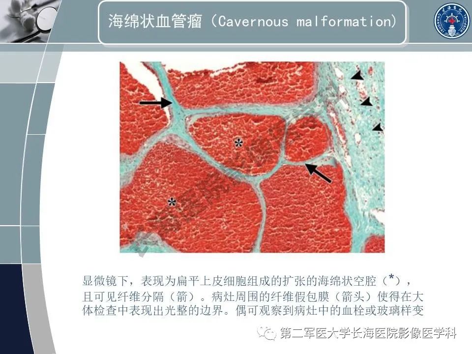 影像PPT - 【PPT】眼眶内肿瘤的影像诊断-37