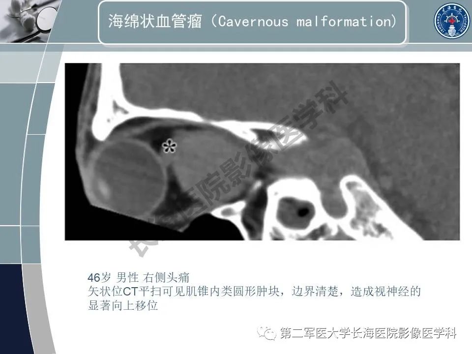 影像PPT - 【PPT】眼眶内肿瘤的影像诊断-39