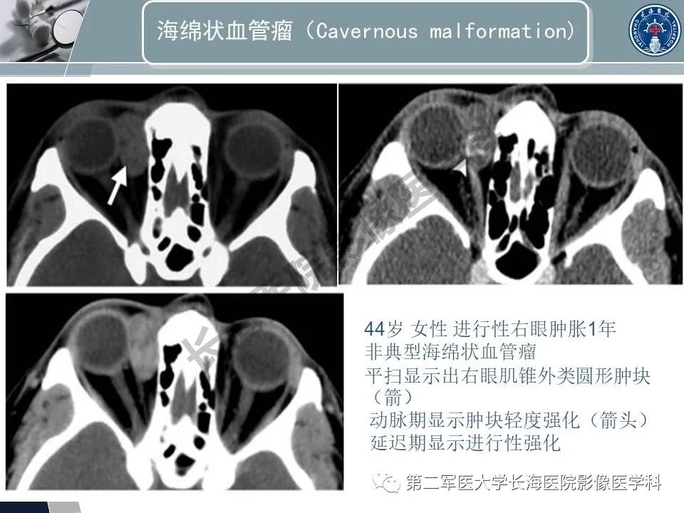 影像PPT - 【PPT】眼眶内肿瘤的影像诊断-40
