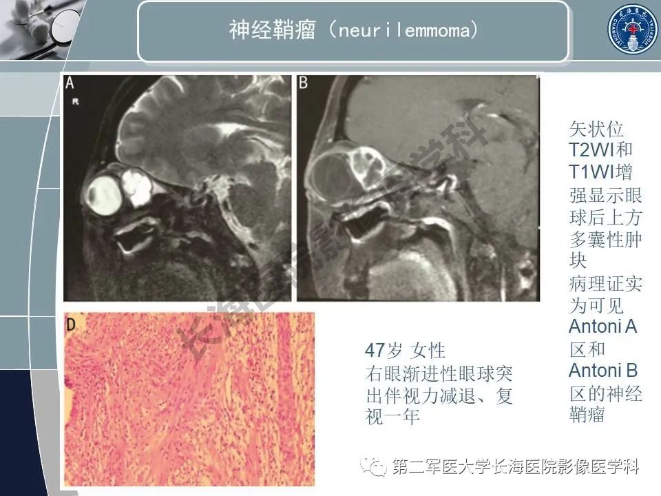 影像PPT - 【PPT】眼眶内肿瘤的影像诊断-45