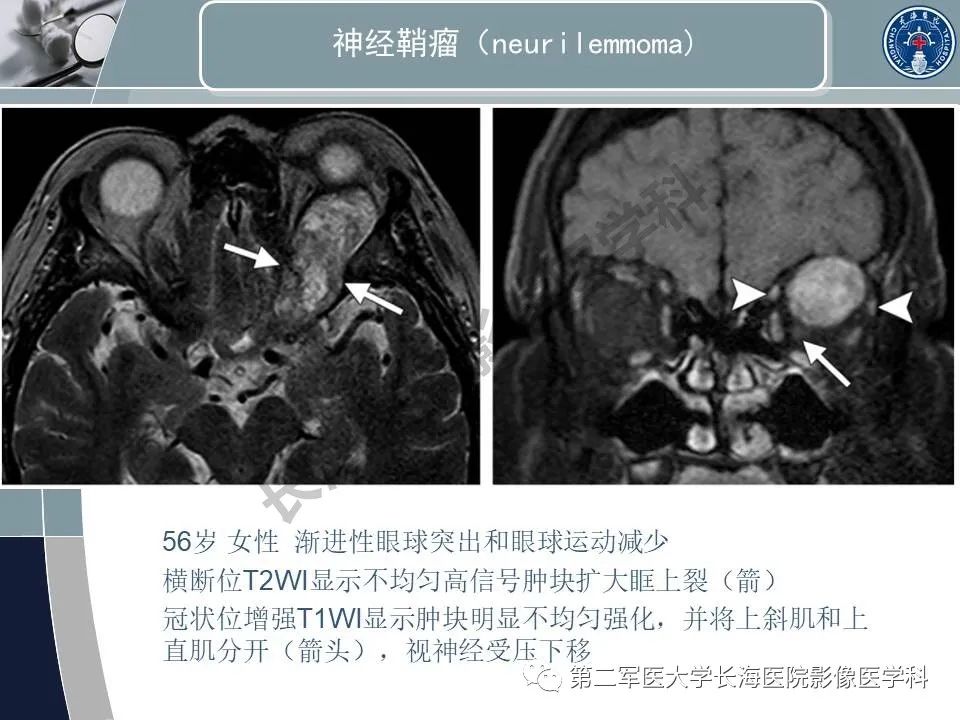 影像PPT - 【PPT】眼眶内肿瘤的影像诊断-46
